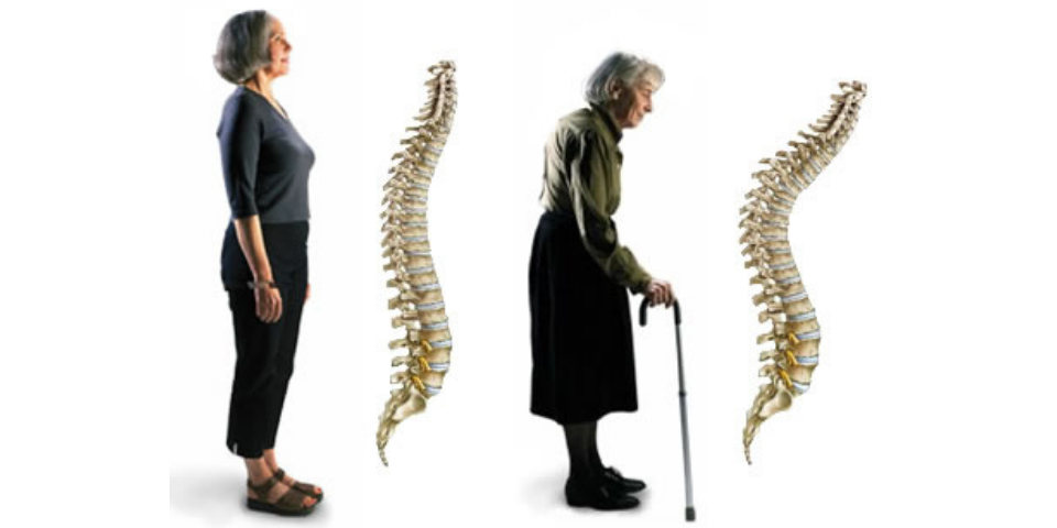 Osteoporosi e mal schiena