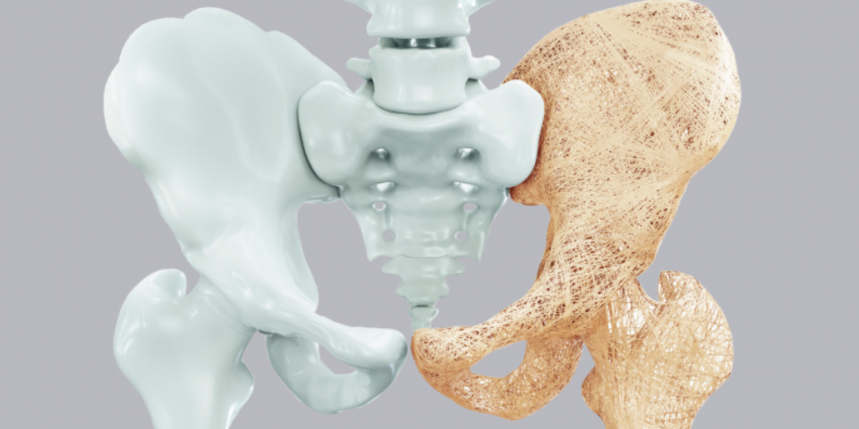 Esercizi ed osteoporosi: incrementare la massa ossea prevenire le fratture